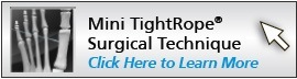mini-tightrope-surgical-tech